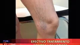 	<p>Tratamiento contra las varices</p>