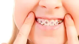 ¿Cuál es la edad recomendada para ponerle brackets a los niños?