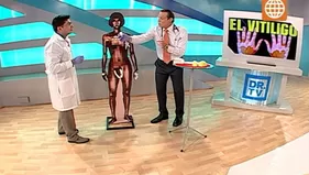 [CAP29/10/13]Doctor TV: Las causas y tratamiento del vitiligo