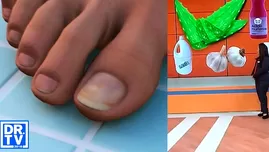 	<p>Remedios caseros que no debes usar para tratar los hongos en las uñas</p>