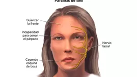 	<p>Parálisis facial</p>