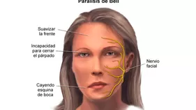 Parálisis facial: pasos para acelerar la recuperación