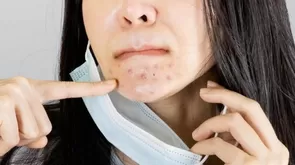 ¿Te salió acné por el uso de la mascarilla? Aquí te contamos cómo combatirlo