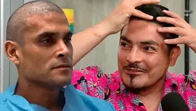 Erick Elera opinó así sobre implante de pelo de Christian Domínguez